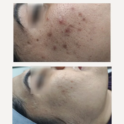 Acne Scar Treatment